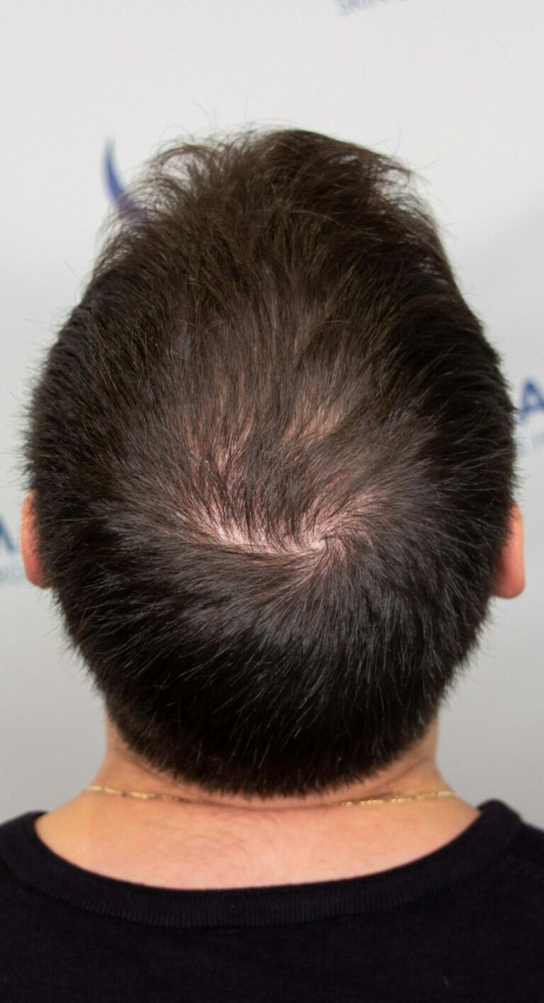 Matthew after hair transplant crown top 1500x2764