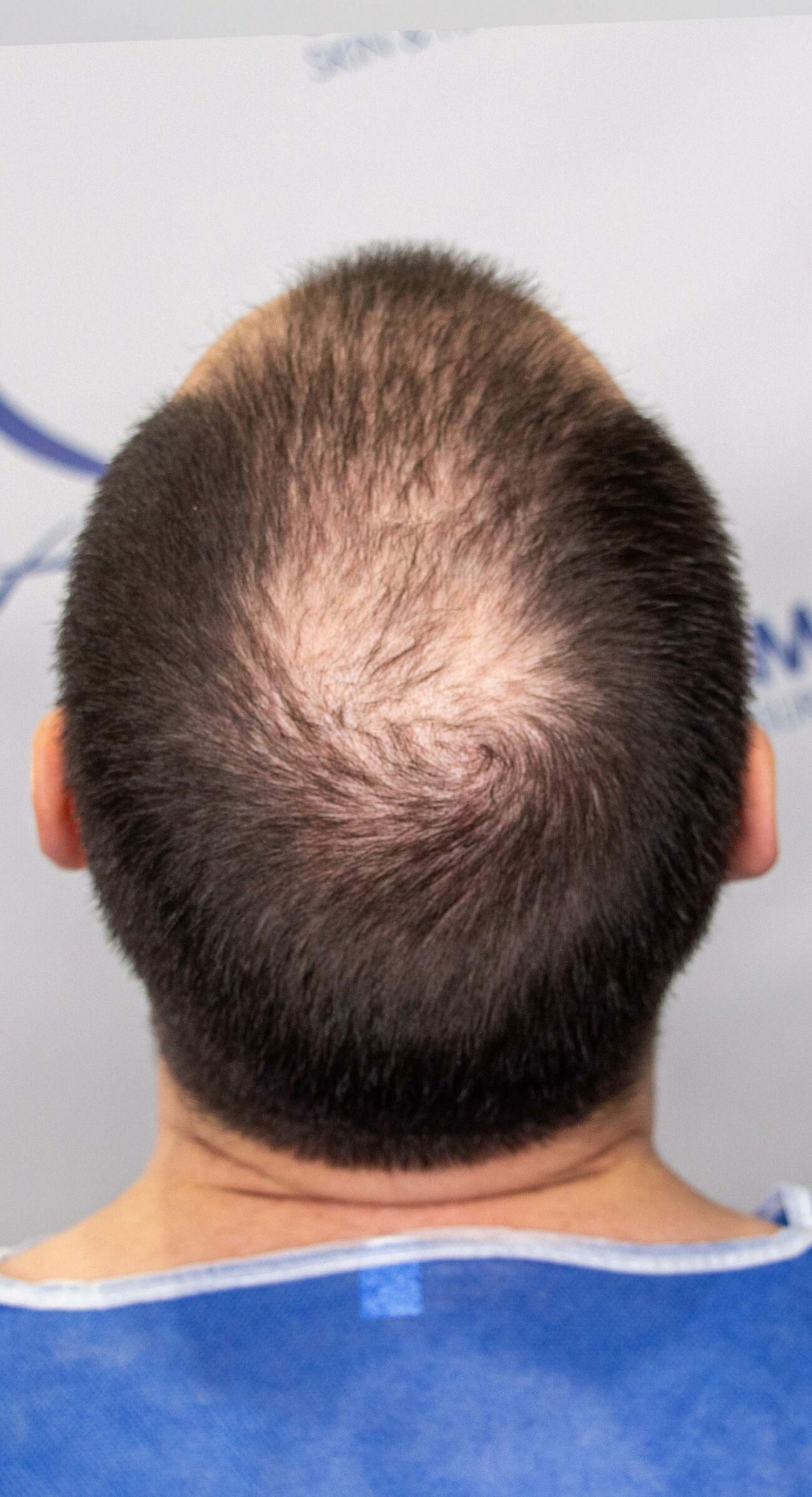 Matthew before hair transplant crown Top 1500x2764