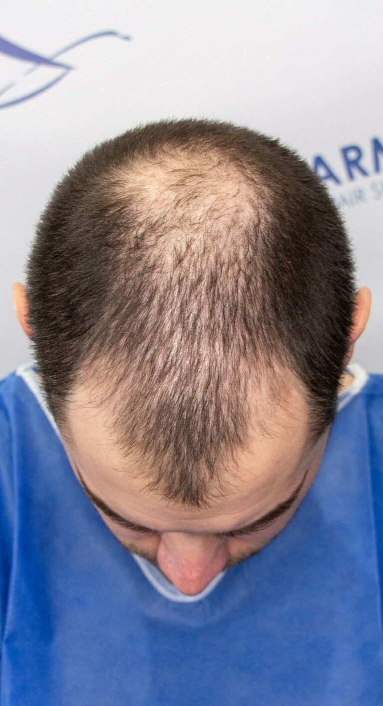 Matthew before hair transplant crown front 1500x2764