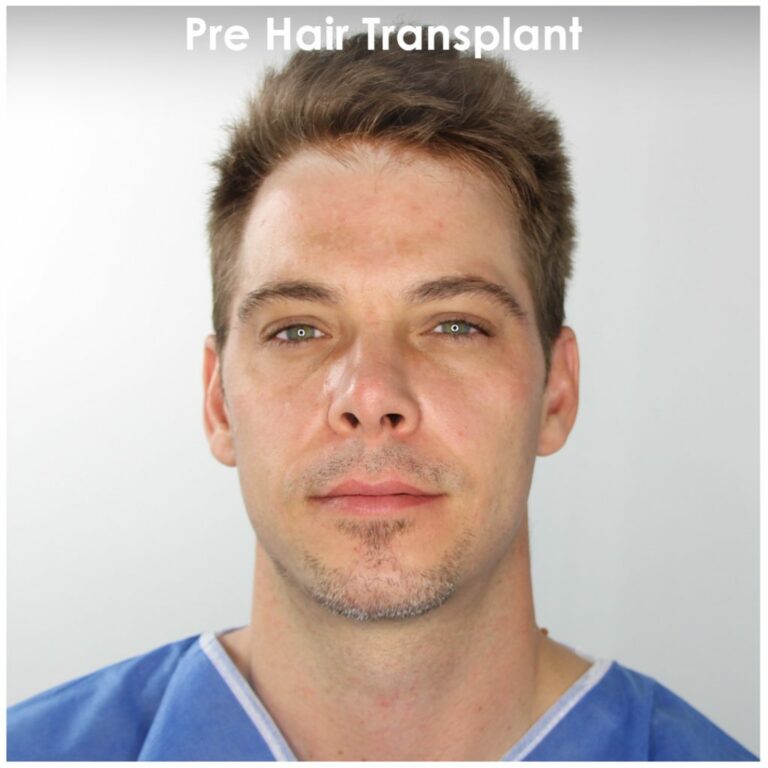 Mitch Pre Hair Transplant 1024x1024 1