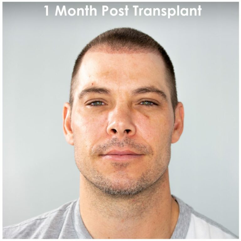 Mitch one Month Post Hair Transplant 1024x1024 1