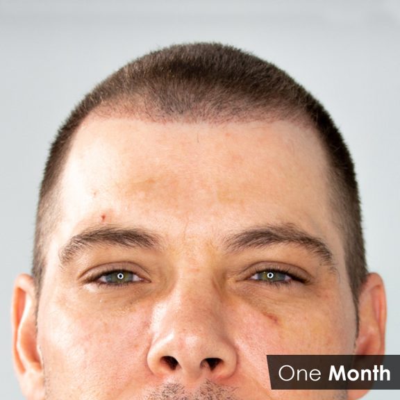 Mitch one Month Post Hair Transplant2 576x576 1