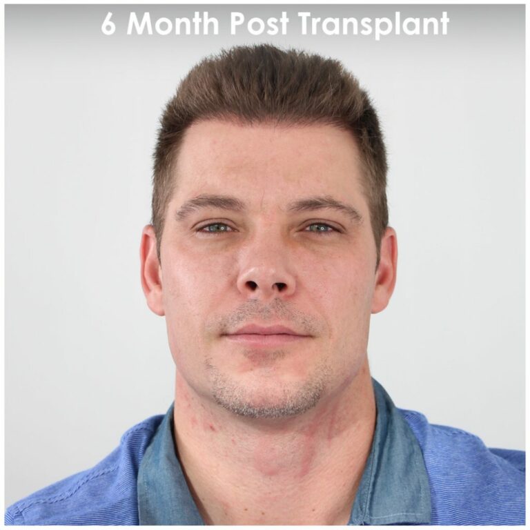 Mitch six months post hair Transplant 1024x1024 1