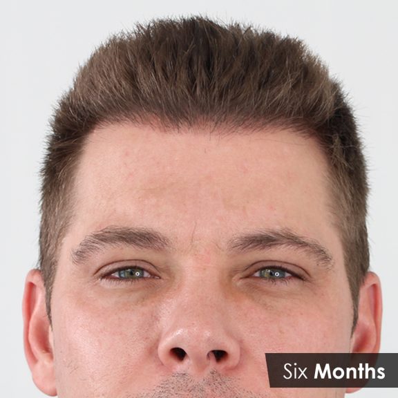 Mitch six months post hair Transplant2 576x576 1