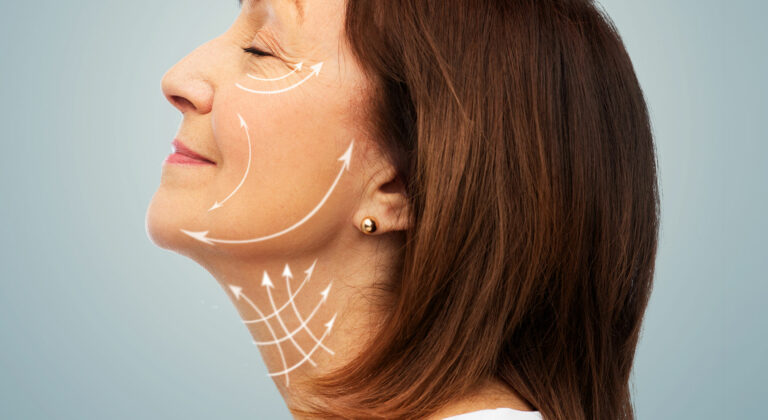 Non Surgical Facelift woman with diagram overlayed