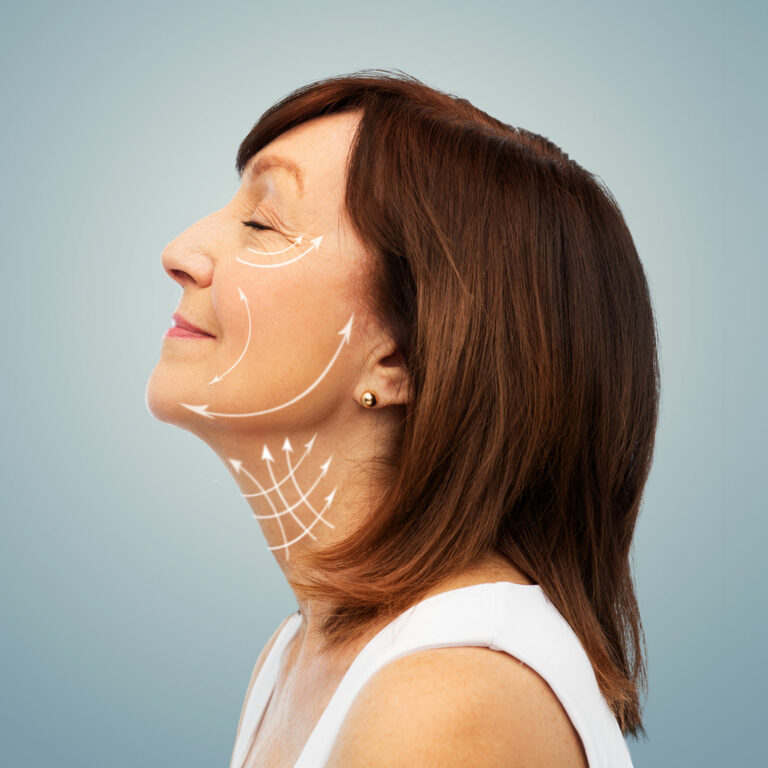 Non Surgical Facelift woman with diagram overlayed