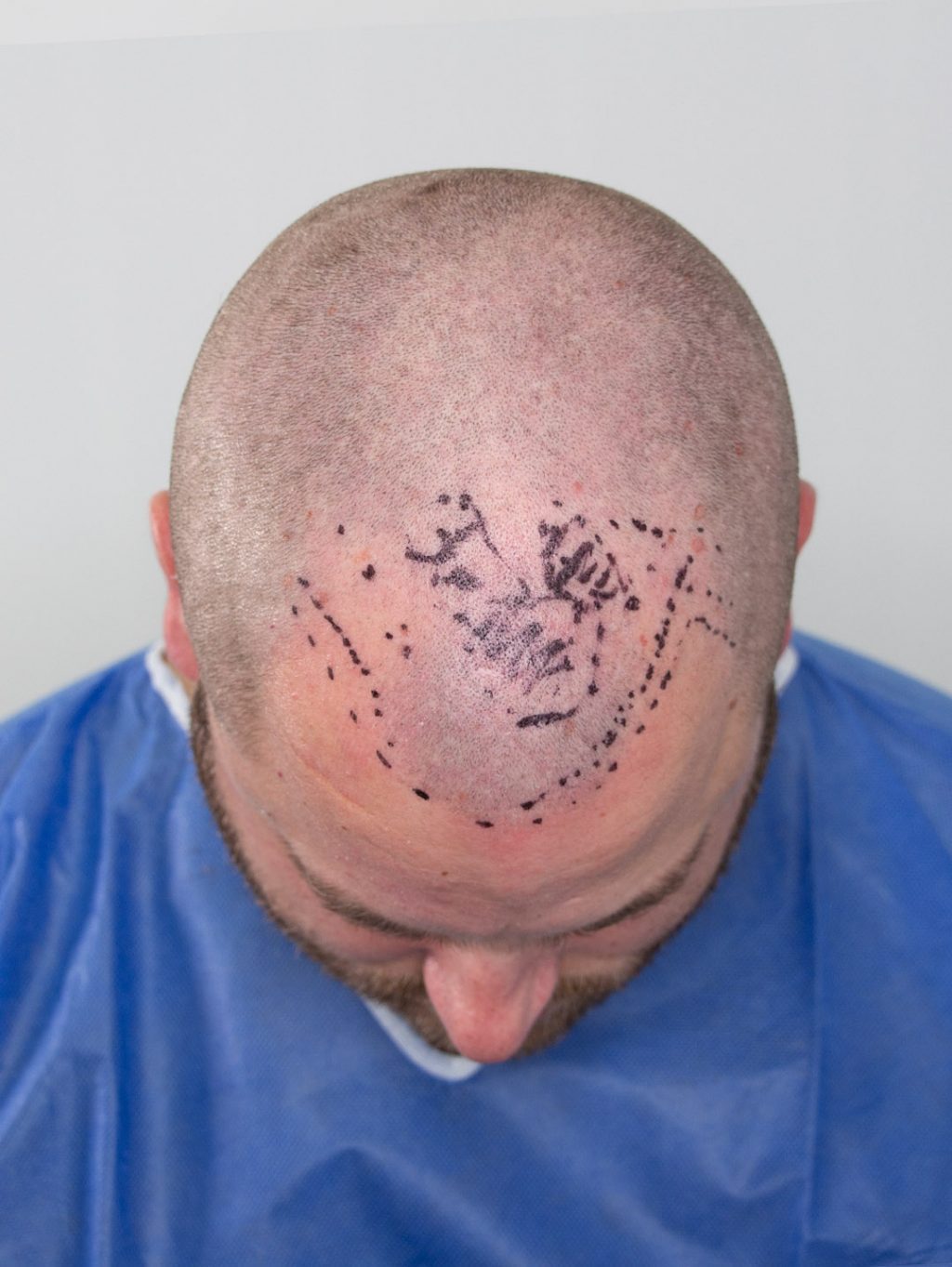 Norwood3A Before hair transplant 4 1024x1363