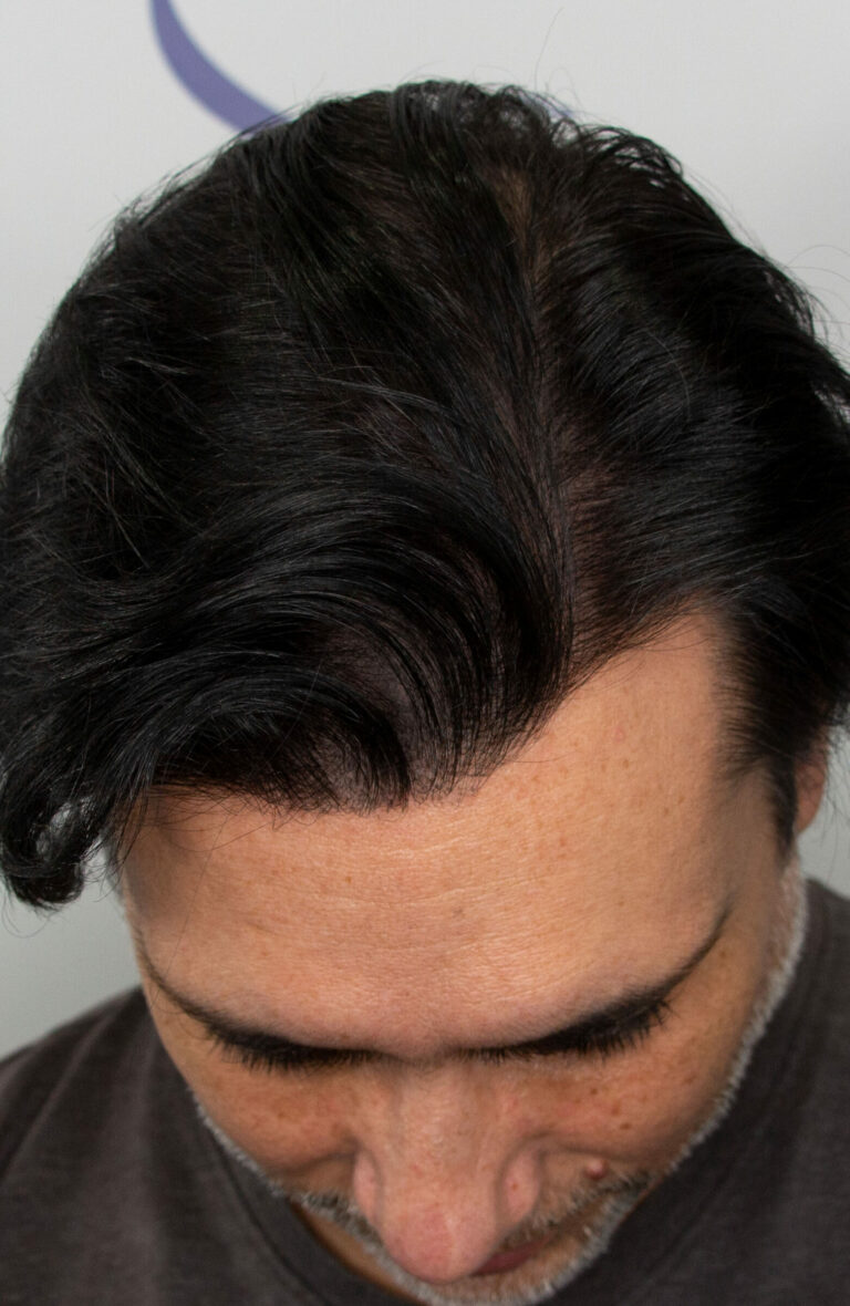 FUE hair transplant in Edmonton