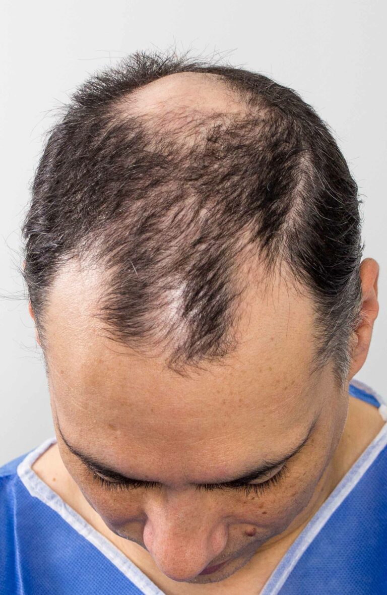 FUE hair transplant in Edmonton