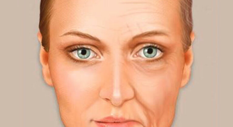 SIgns of facial aging