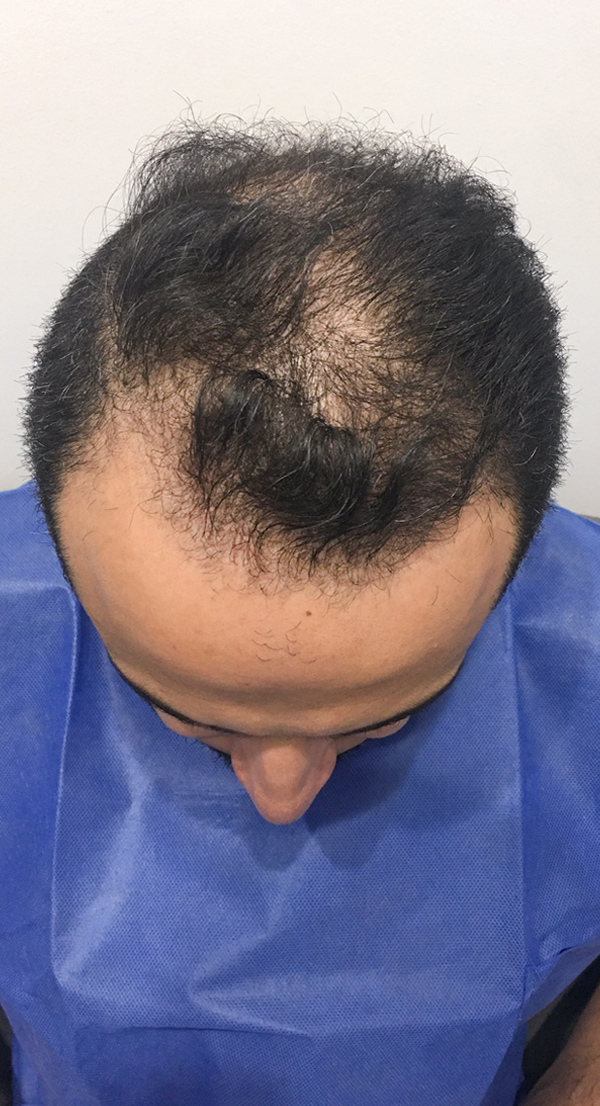 Sami Hair Transplant Before photo top