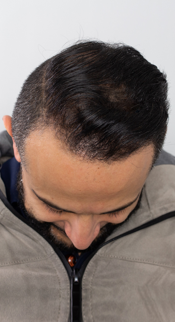 Sami Hair Transplant after photo top