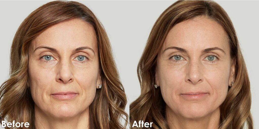 Sculptra Corporate Before and after V1