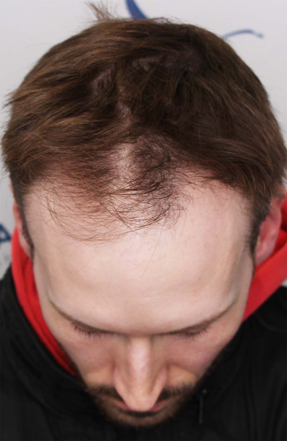 hair transplant hair line edmonton