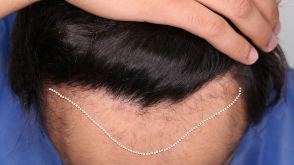 Traction alopecia visible on man from tightly worn turban2 1024x758