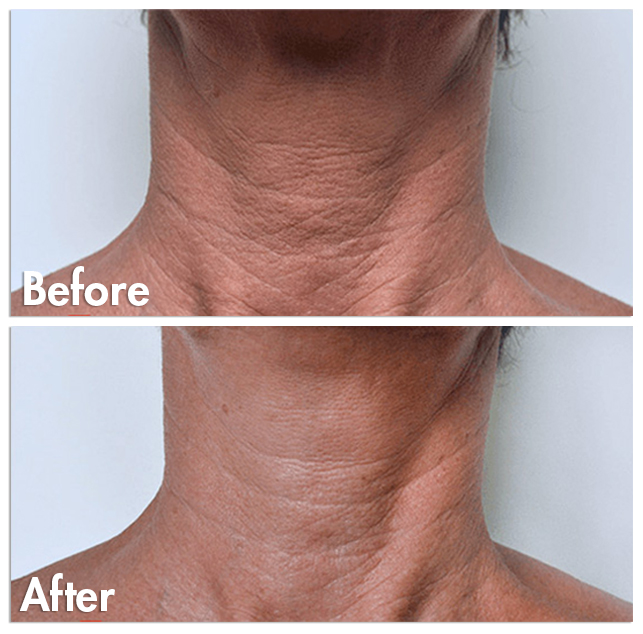 V2 Beautybooster womans neck tightening in edmonton