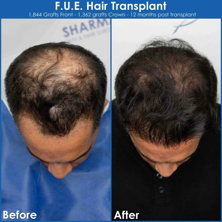 Very large bald spot hair restoration before and after photo scaled