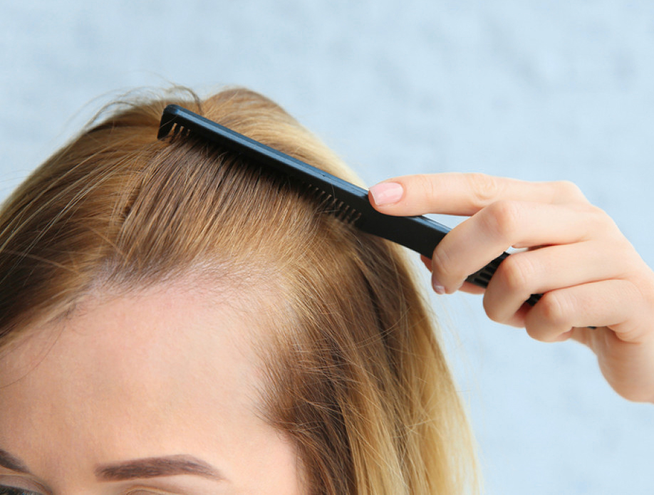 Young woman with hair loss sharma