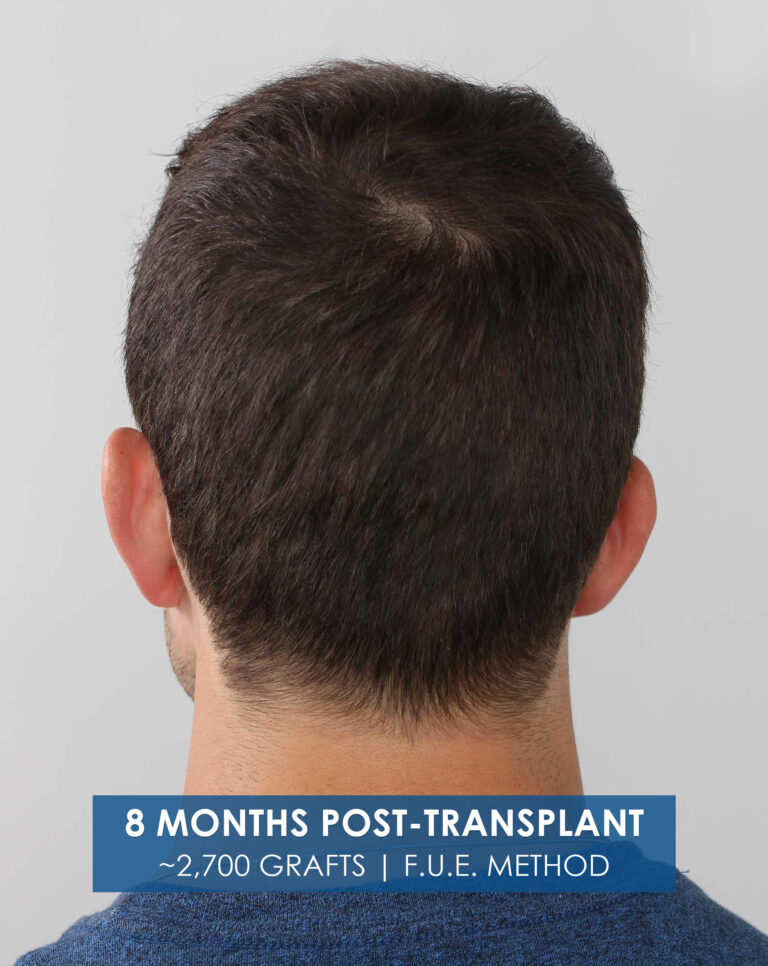 back of the head 8 months after hair transplant FUE 1