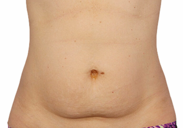 coolsculpt abdomen before