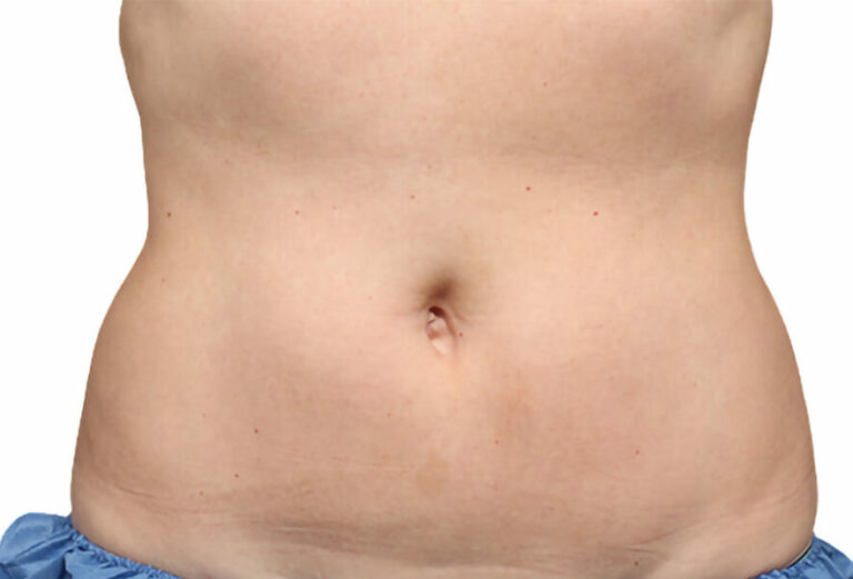 coolsculpt stomach fat after