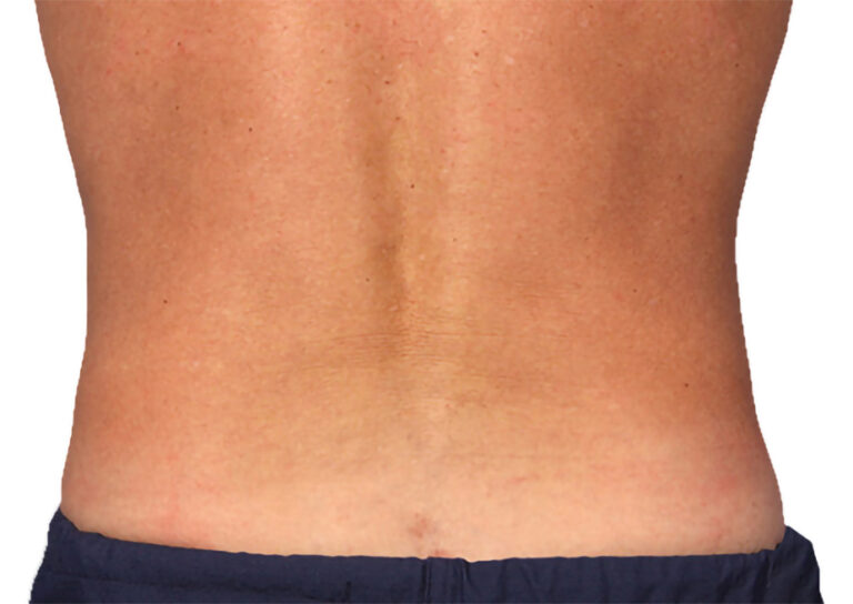 coolsculpting back after