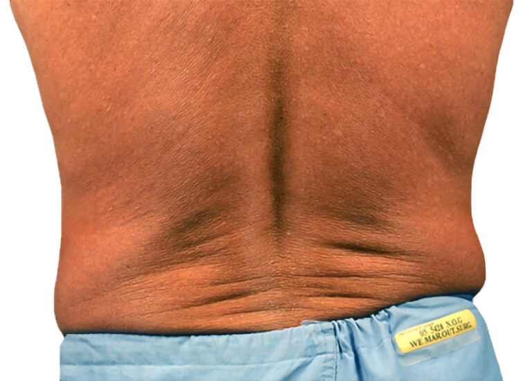 coolsculpting back before