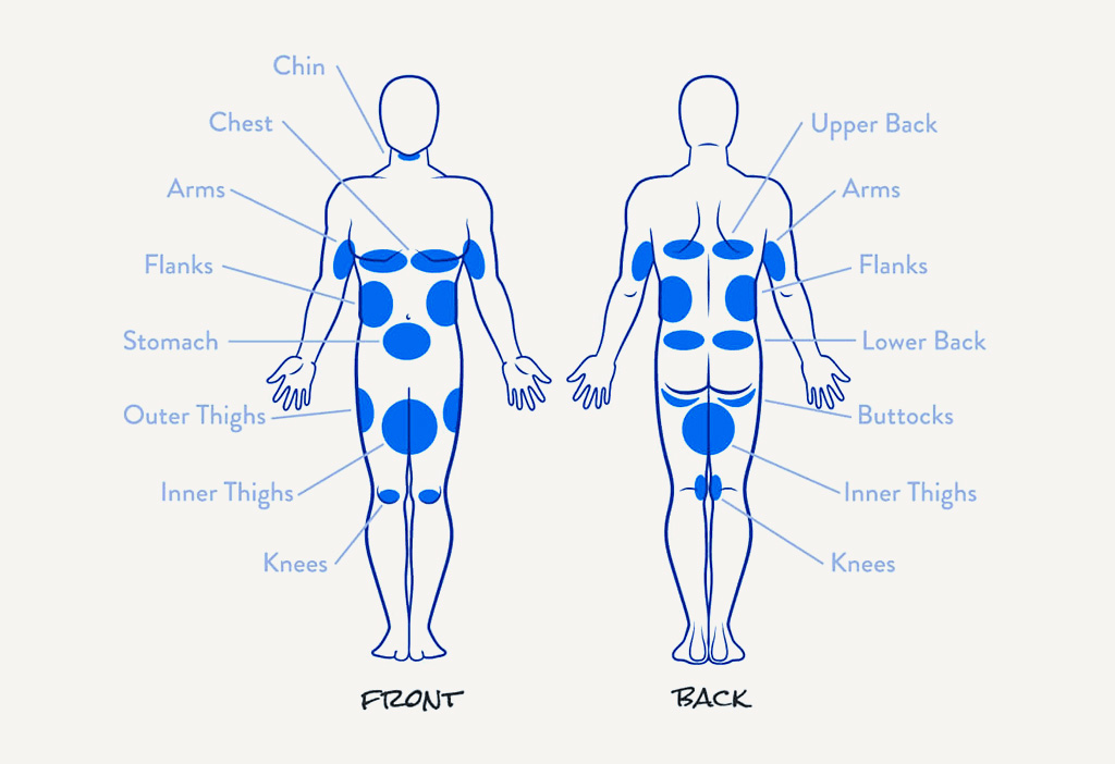 coolsculptingdiagram