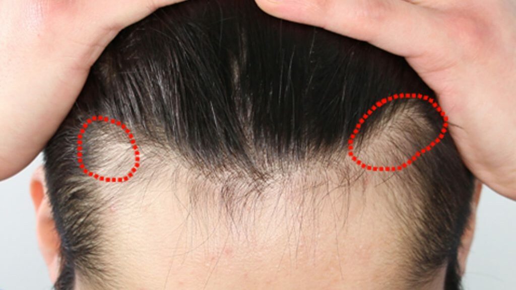 early signs of traction alopecia 1 1024x758