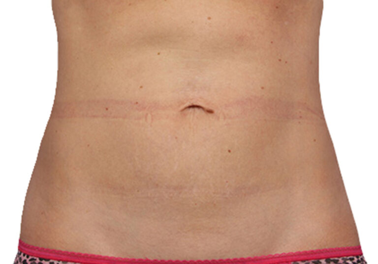 female coolsculpt abdomen after