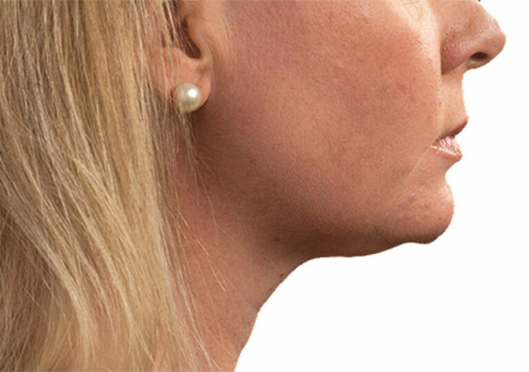 female coolsculpt chin before and after 2