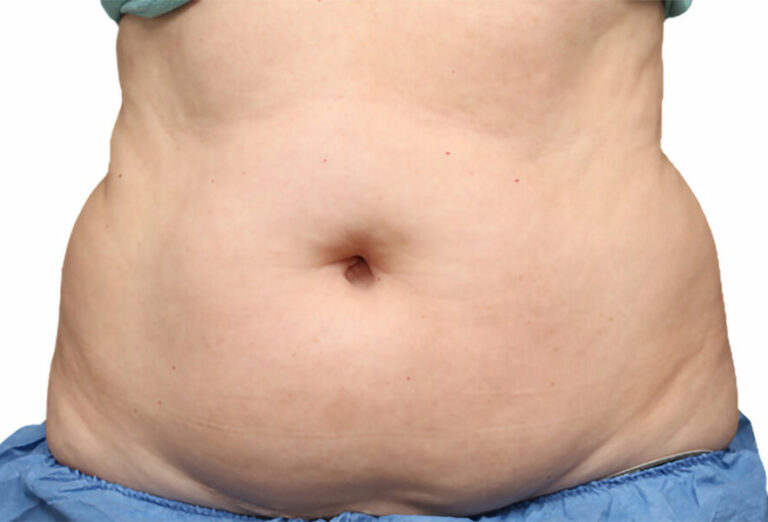 Best CoolSculpting Edmonton For Stubborn Fat Removal