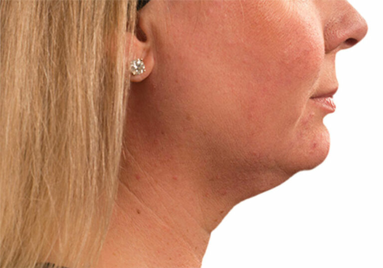 female coolsculpting chin neck before and after