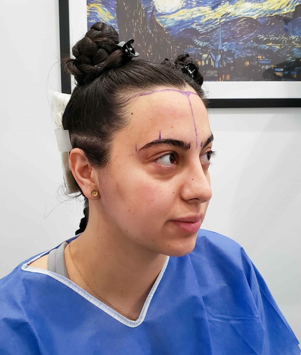 female hair transplant to bring down hairline 1 scaled
