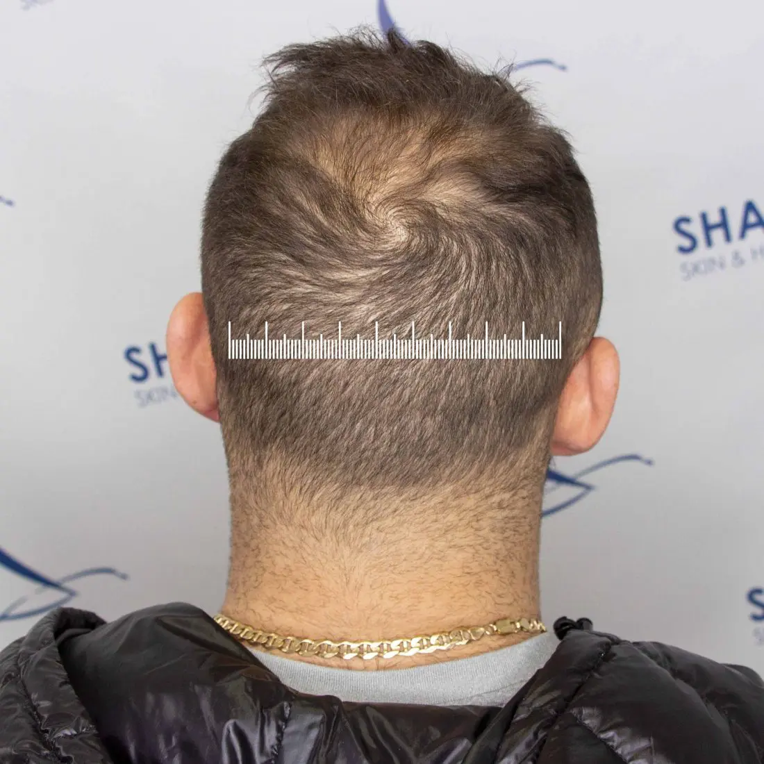 Can I get an FUE hair transplant without anyone knowing?