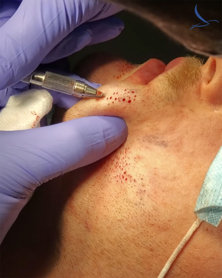 inserting grafts into a beard