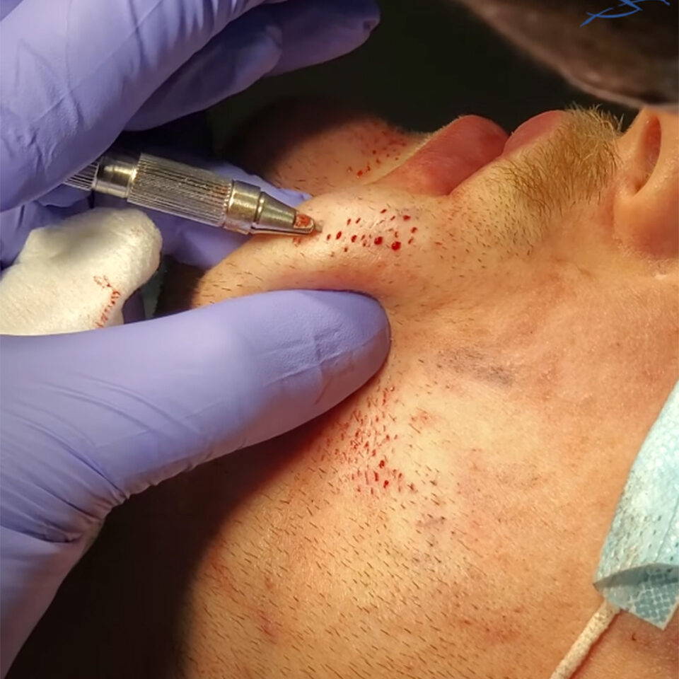 inserting grafts into a beard
