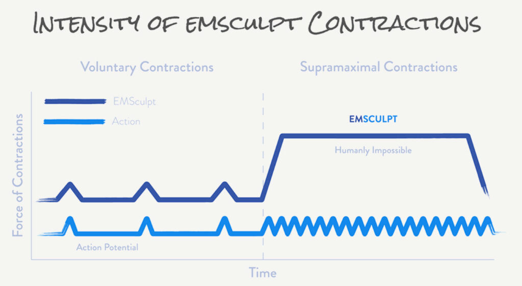 intensity of emsculpt contractions