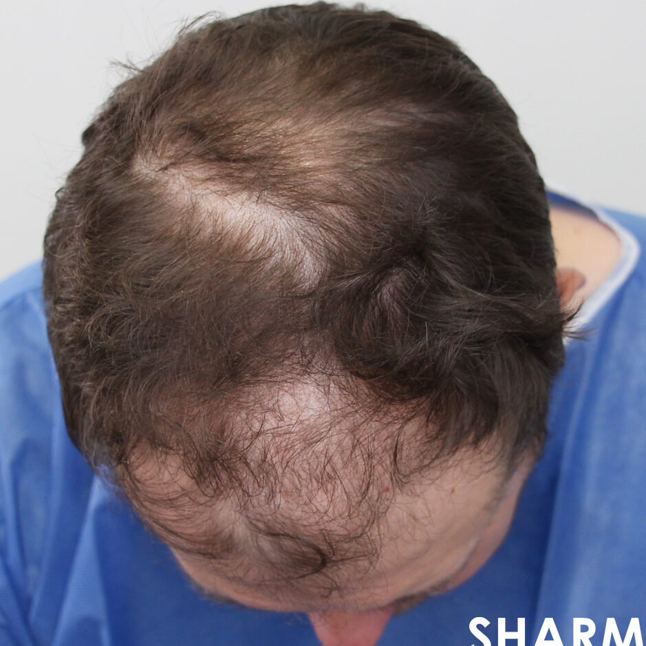 male pattern hair loss Androgenetic Alopecia