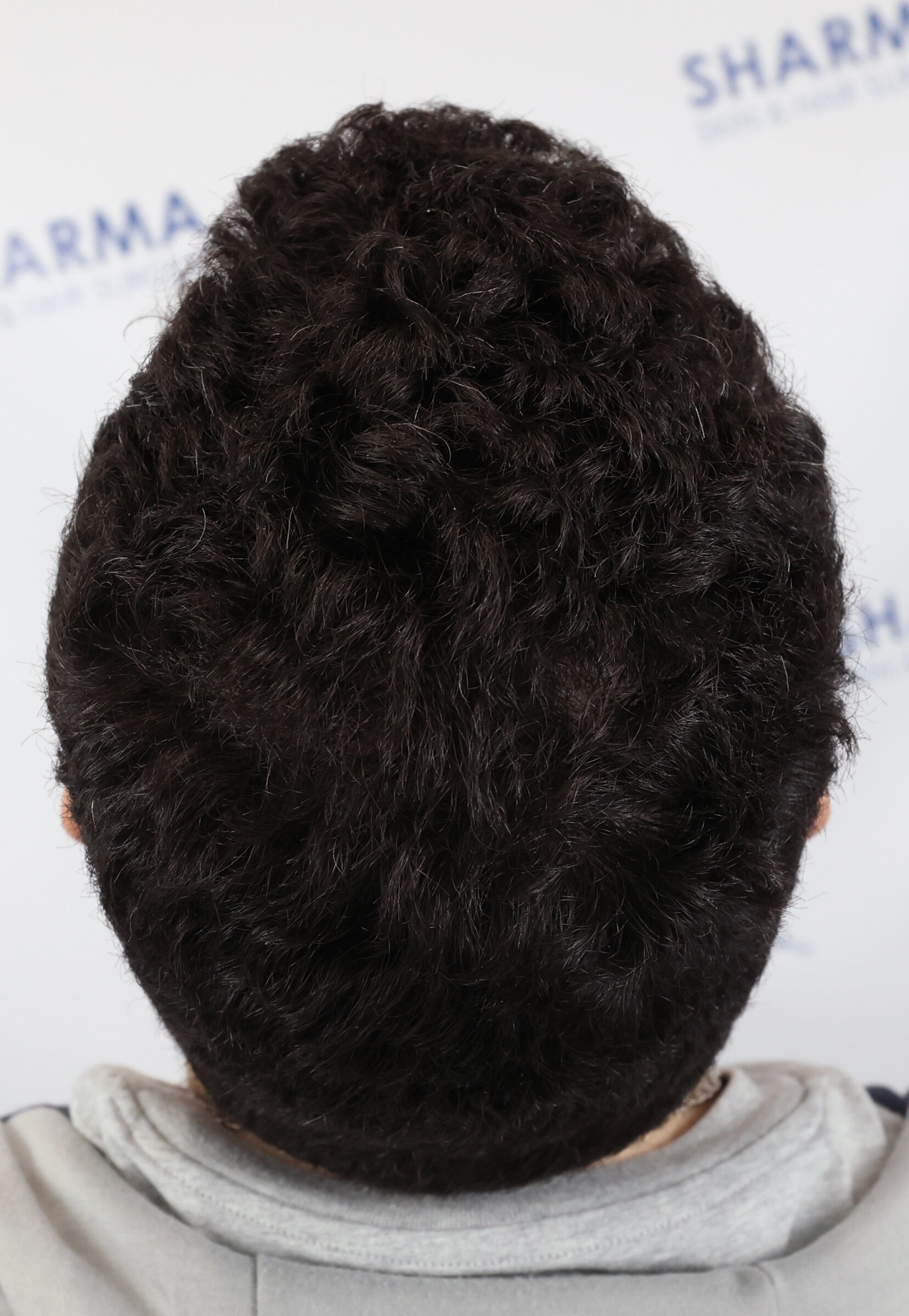 FUE hair transplant with 1500 grafts