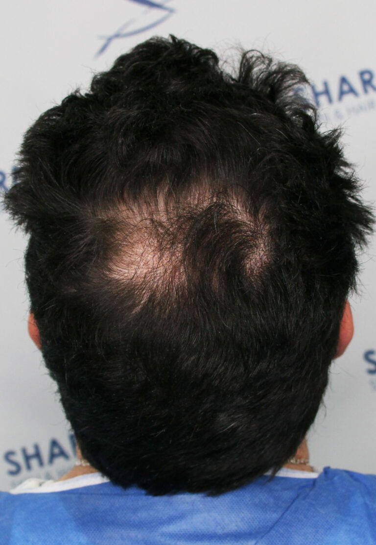 Dawoad Before 34yo 1500 grafts crown area Back