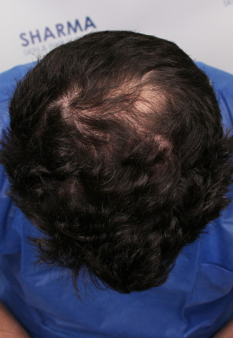 Dawoad Before 34yo 1500 grafts crown area Front