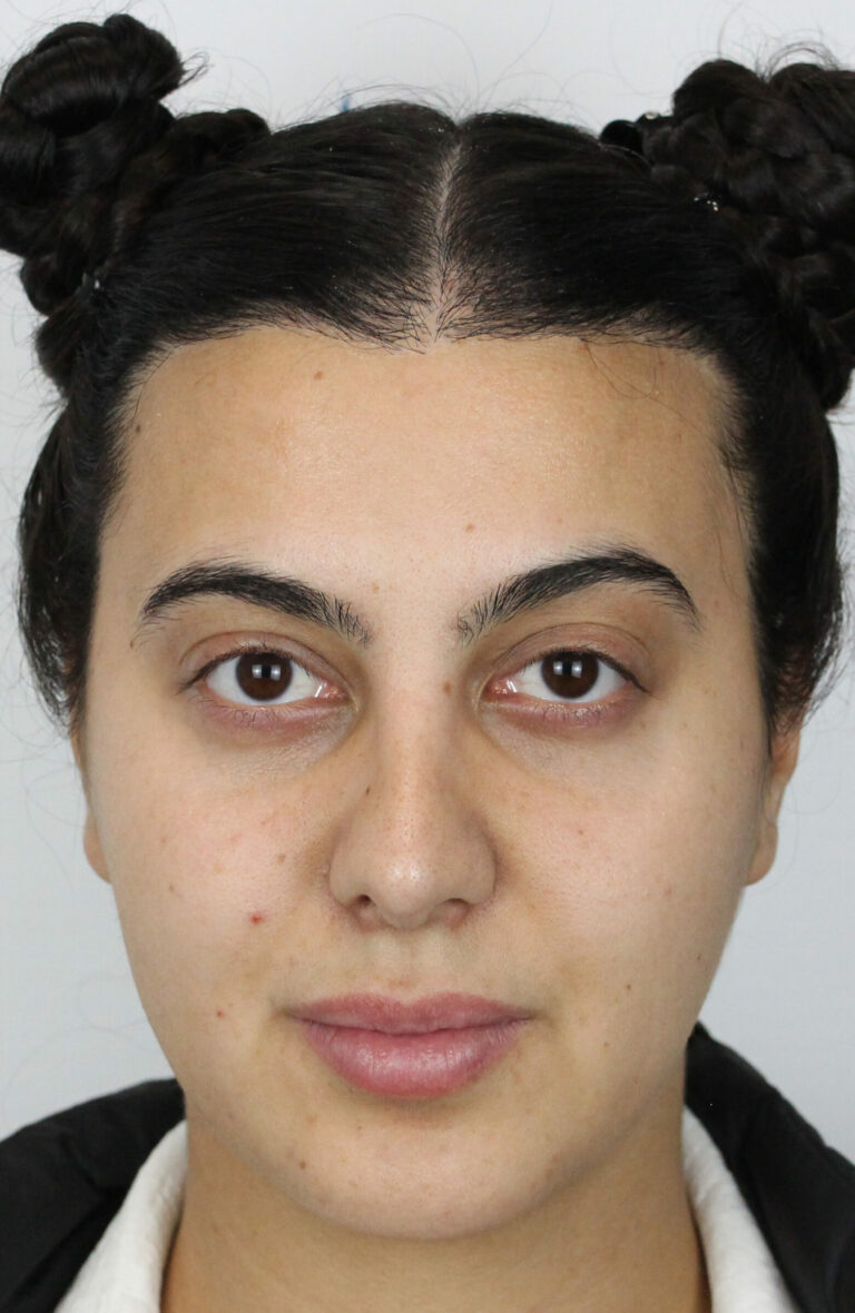 Female FUT hair transplant