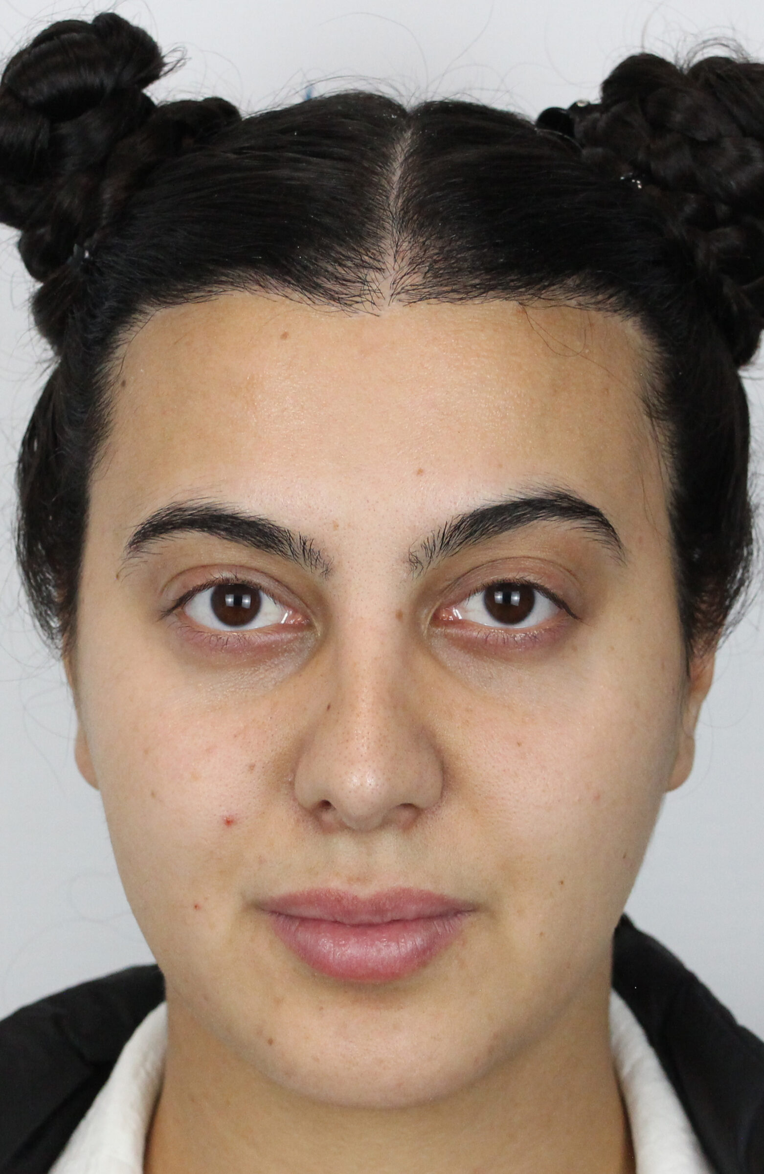 Female FUT hair transplant