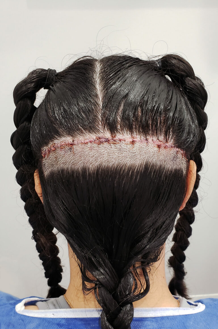 Female FUT hair transplant