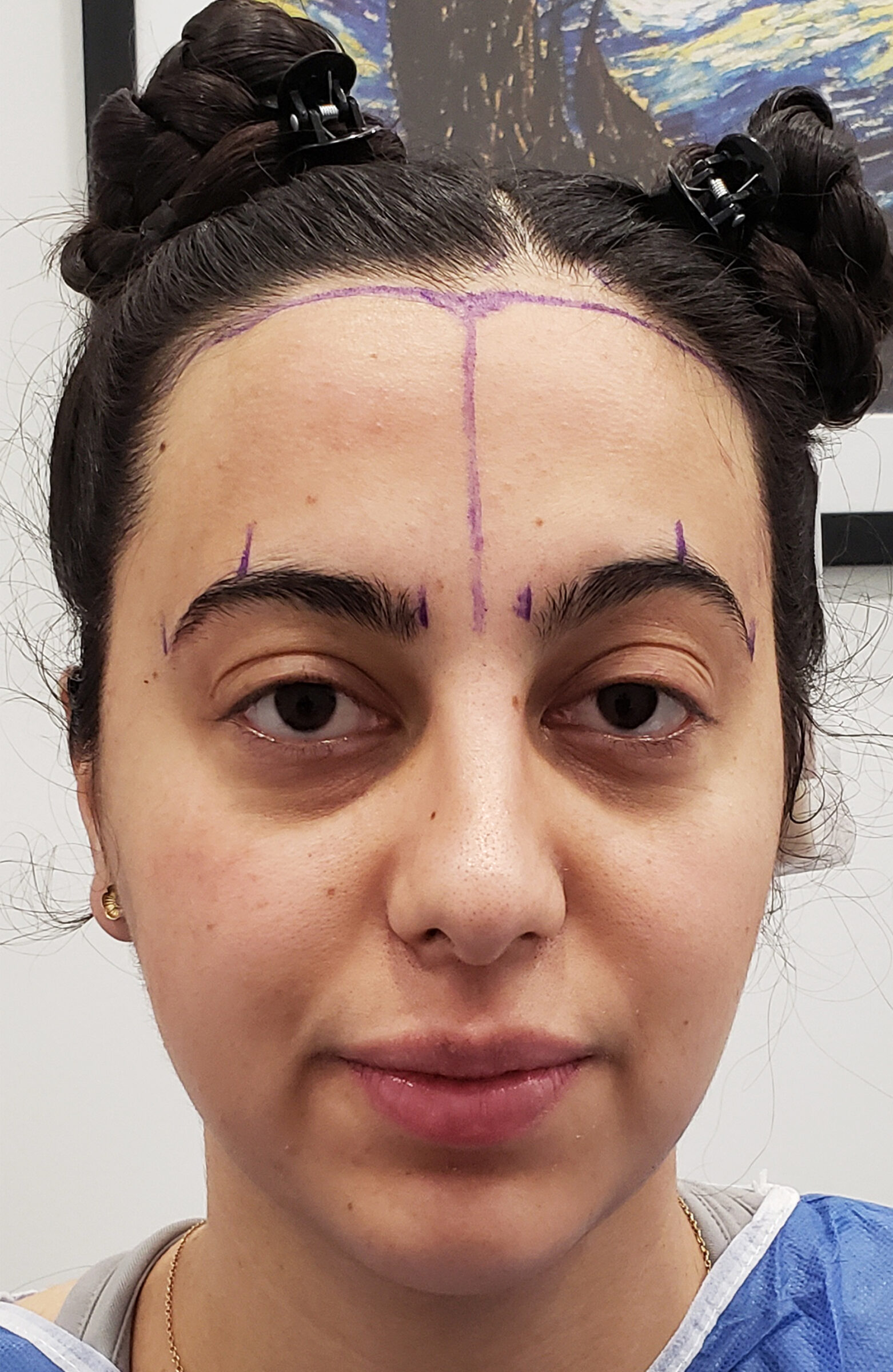 Female FUT hair transplant