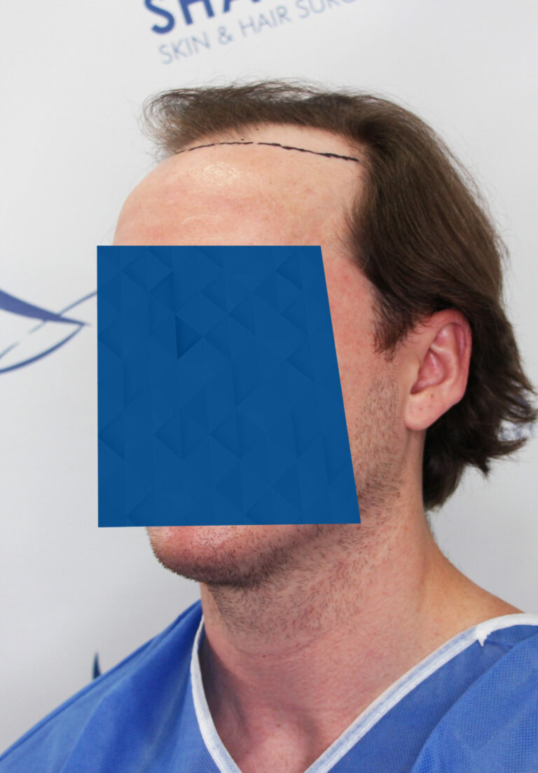 FUE Hair transplant Edmonton Vancouver