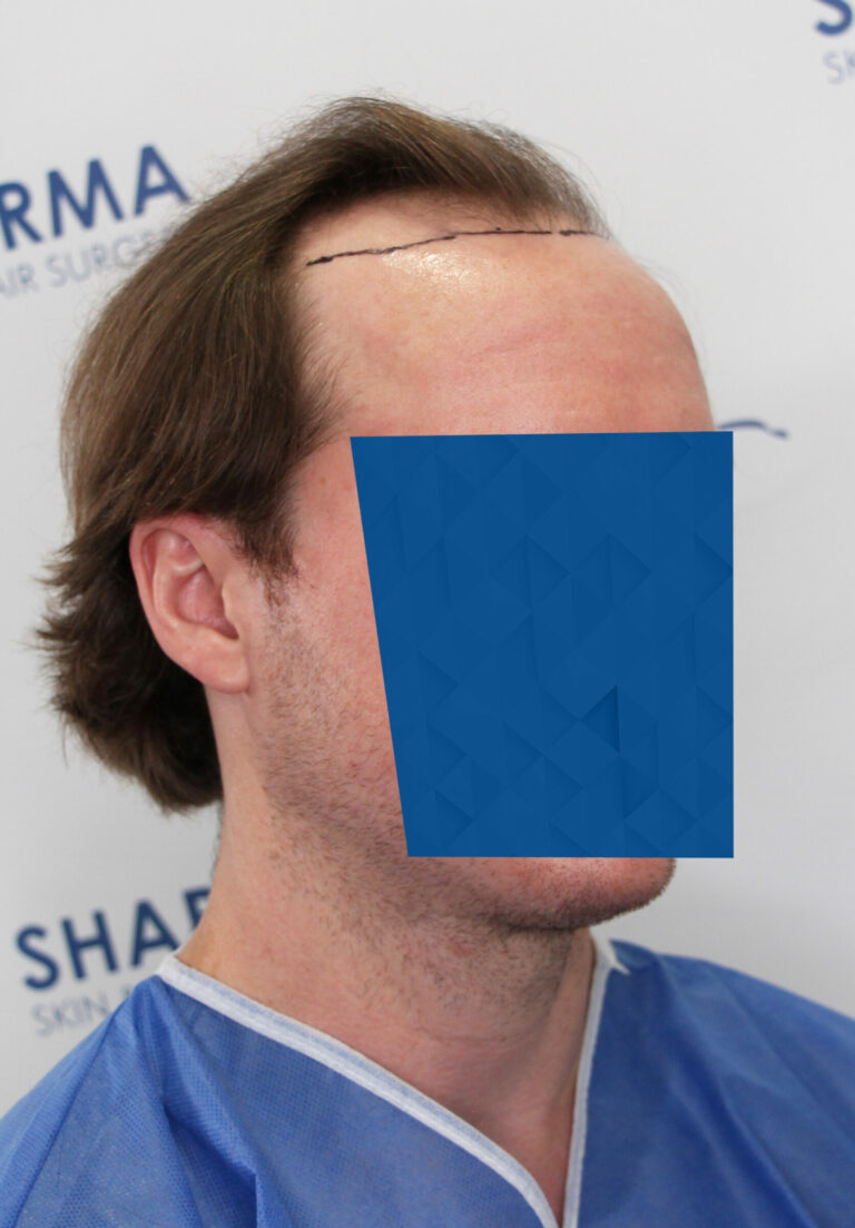 FUE Hair transplant Edmonton Vancouver