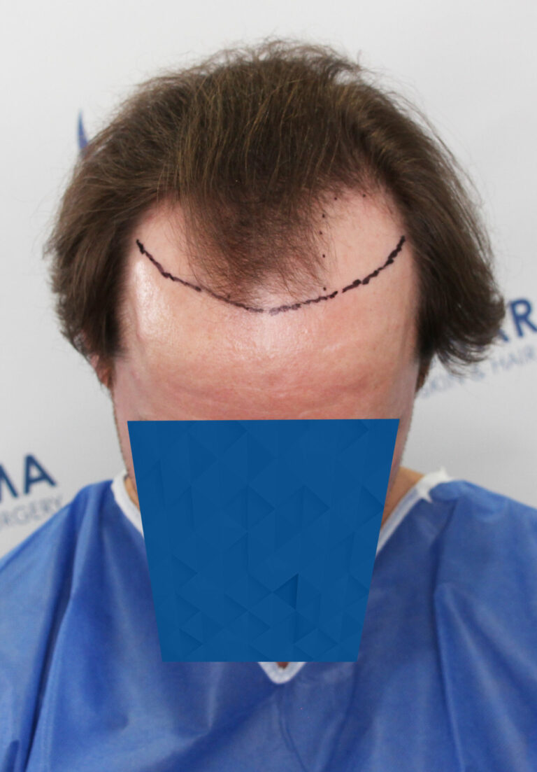 FUE Hair transplant Edmonton Calgary