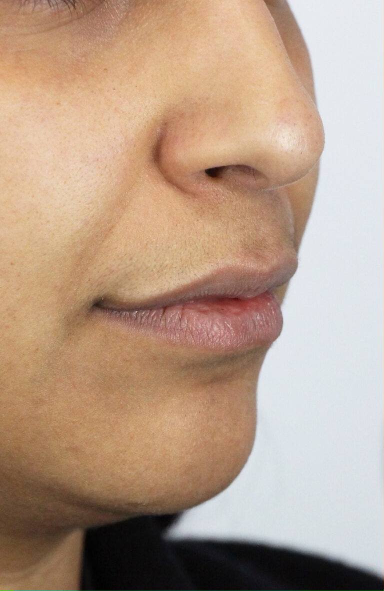 Lip Fillers Edmonton Before